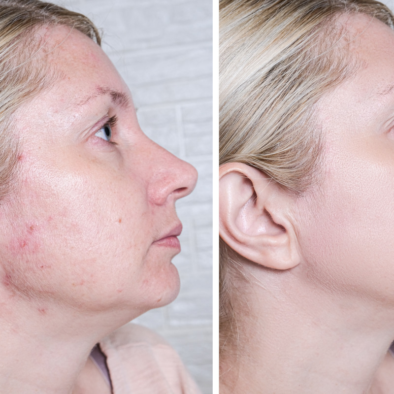 Acne Treatments