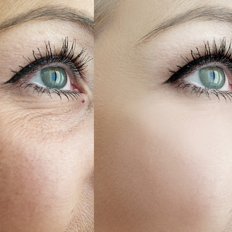 BOTOX®