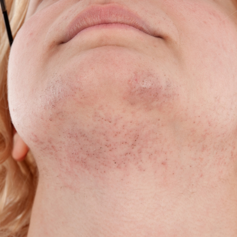 Hirsutism