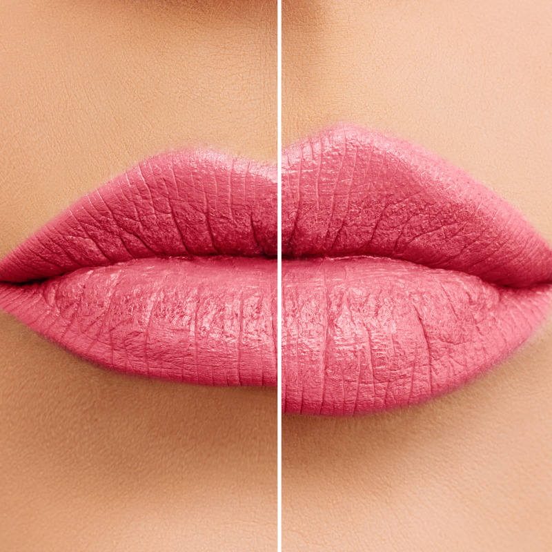 Injectable Dermal Fillers