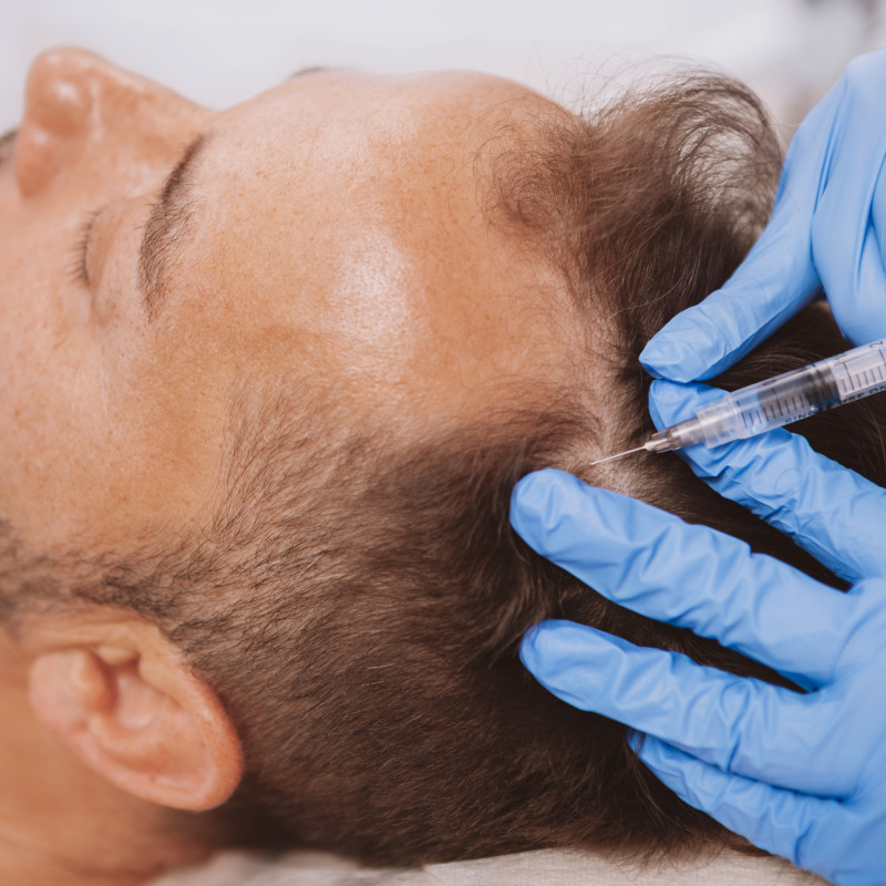 PRP Therapy for Hair Loss